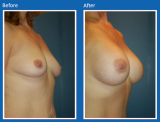 breast-augmentation-34