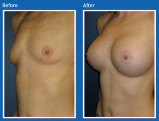 breast-augmentation-36