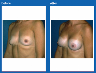 breast-augmentation-37