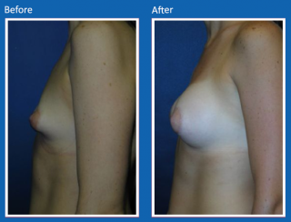 breast-augmentation-38