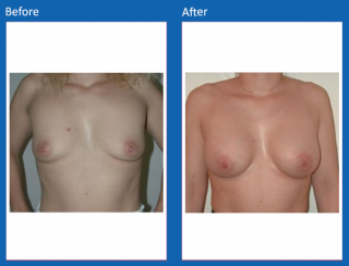 breast-augmentation-39