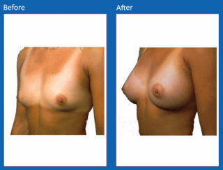 breast-augmentation-40