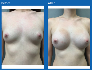 breast-augmentation-41