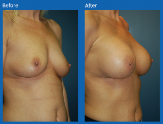 breast-augmentation-42