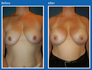 breast-augmentation-43