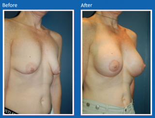 breast-augmentation-44