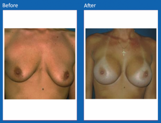 breast-augmentation-45