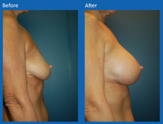 breast-augmentation-46