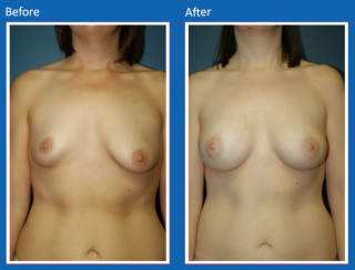 breast-augmentation-47