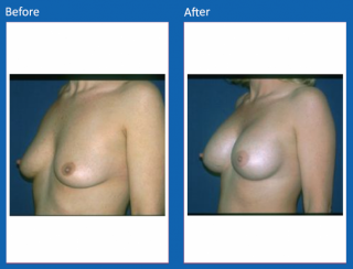 breast-augmentation-48