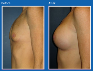 breast-augmentation-49