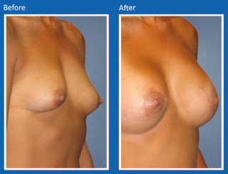 breast-augmentation-5