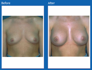 breast-augmentation-50