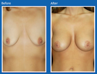 breast-augmentation-51