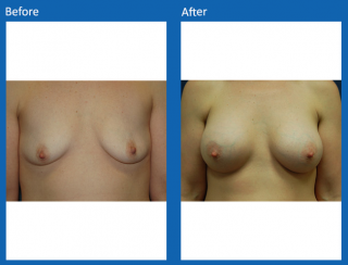 breast-augmentation-52