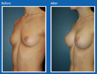 breast-augmentation-53
