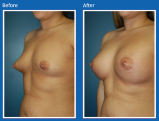 breast-augmentation-54