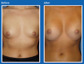 breast-augmentation-55