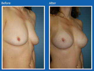 breast-augmentation-56