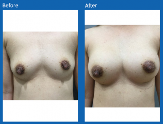 breast-augmentation-57