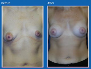 breast-augmentation-58