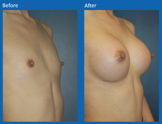breast-augmentation-59
