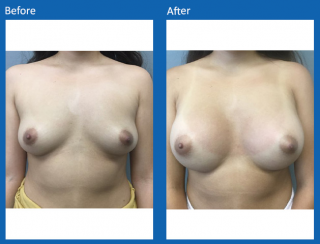 breast-augmentation-6