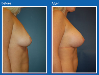 breast-augmentation-60