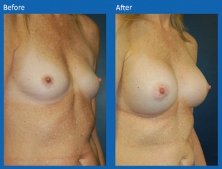 breast-augmentation-61