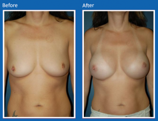 breast-augmentation-62