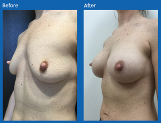 breast-augmentation-63