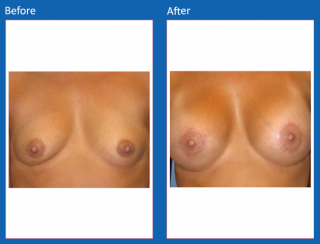 breast-augmentation-64