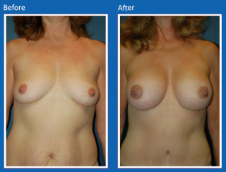breast-augmentation-65