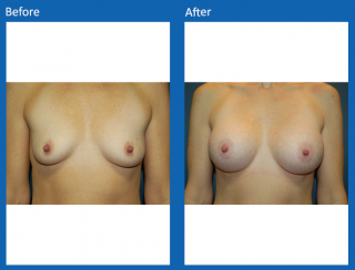 breast-augmentation-66