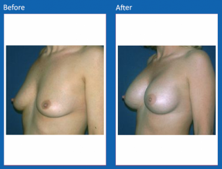 breast-augmentation-67