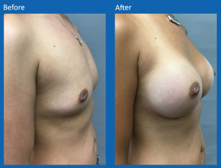breast-augmentation-68