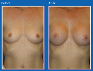 breast-augmentation-69