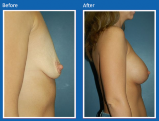 breast-augmentation-7