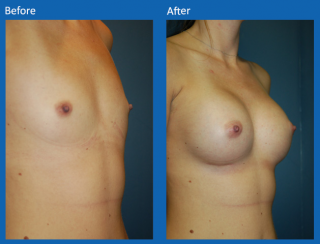 breast-augmentation-70