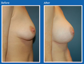 breast-augmentation-71