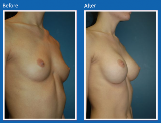 breast-augmentation-72
