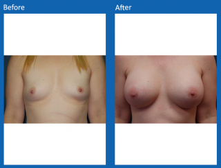 breast-augmentation-73