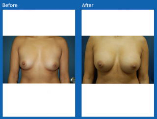 breast-augmentation-74
