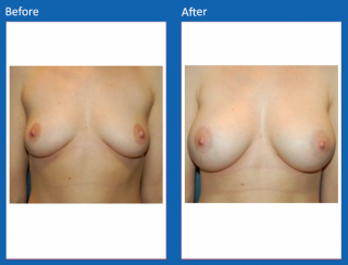 breast-augmentation-75
