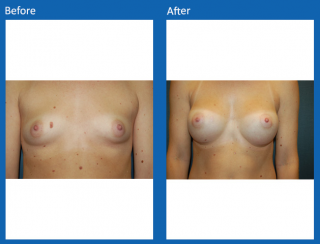 breast-augmentation-76