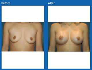 breast-augmentation-77