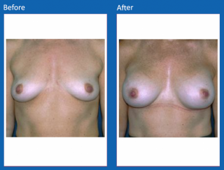 breast-augmentation-78