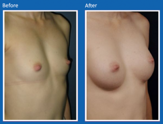 breast-augmentation-8