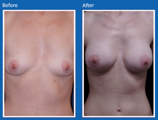 breast-augmentation-9