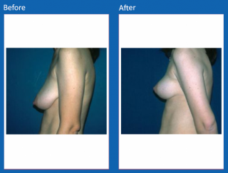 breast-lift-reduction-1